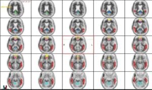 brain scan images